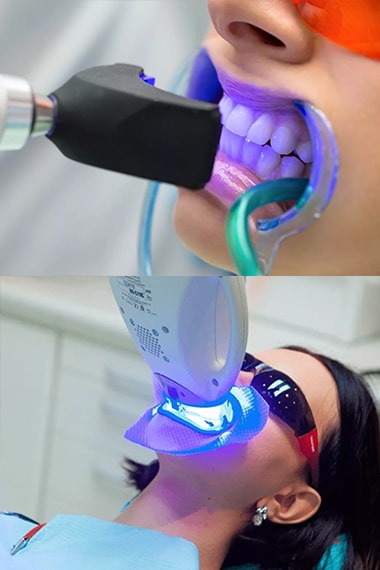 Отбеливание зубов led лампой (Стоматология Сити Смайл в Химках)