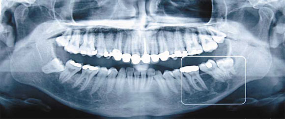 Снимок челюстей и зубов 3d