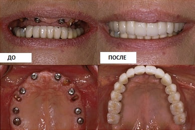 Установка зубных имплантов в Химках (стоматология Сити Смайл)