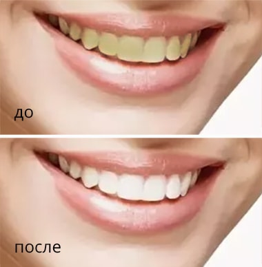 отбеливание зубов химки отбеливание зубов химки