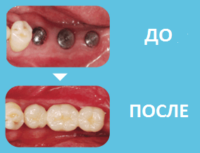 Установка зубных имплантов в Химках (Стоматология Сити Смайл)