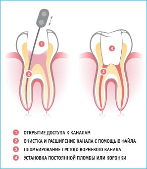 Лечение кариеса в Химках